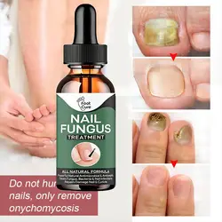 Nail Fungus Treatment Feet Care Essence Nails Foot Repair Toe Nail Fungal Removal Onychomycosis Gel Anti Infection Paronychia