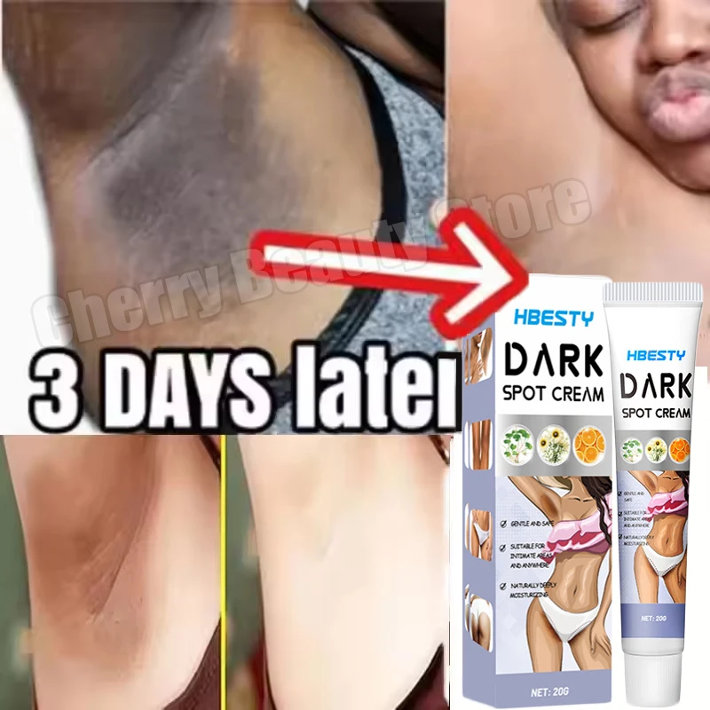 كريم تبييض الأجزاء الخاصة تحت الإبط مصل تبييض تبييض بعقب الركبة سطع الفخذ الداخلي الأجزاء الحميمة إزالة الميلانين الداكن