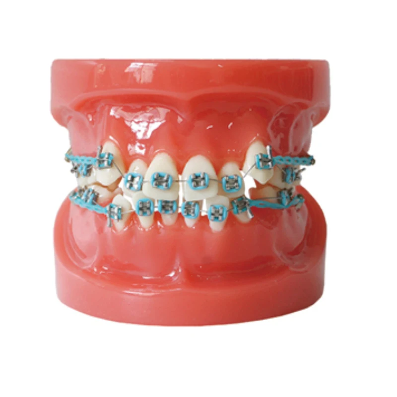 Dental Orthodontic Treatment Teeth Model Malocclusion Correction With Metal Brackets Teach Models for Patient Communication