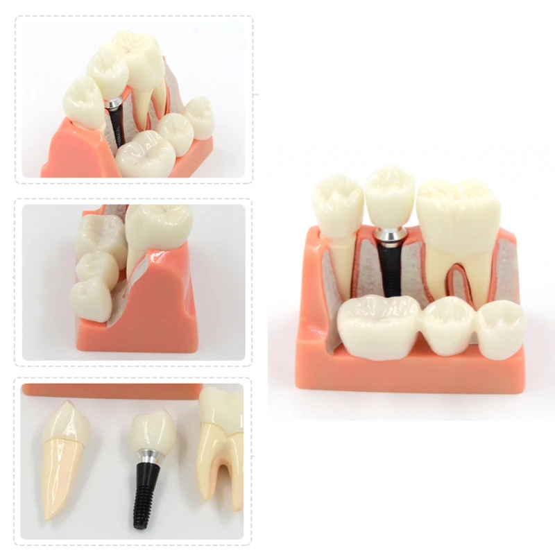 

Dental Model 4 Times Dental Implant Analysis Crown Bridge Demonstration Dental Teeth Model Dentist Teaching Dentistry Clinic