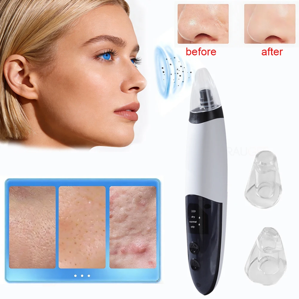 Electric Blackhead …