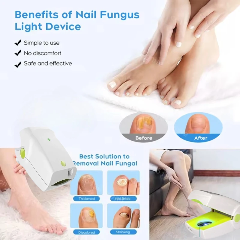 

Compact Nail Fungus Laser - 905nm Deep Therapy & 470nm Surface Disinfection
