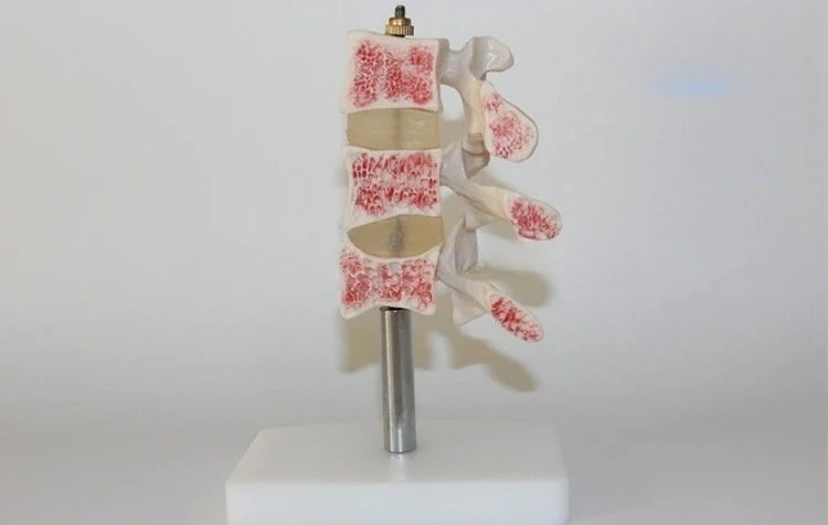 Lesion spinal model Spine model Intervertebral disc model