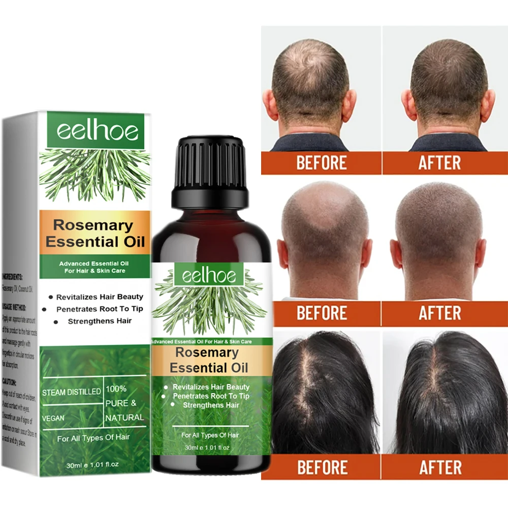 

Rosemary Oil For Hair Growth Pousse De Cheveux Oleo Para Cabelos Crecimento Cabello Mujer Rapido Capilar Olio Rosmarino Capelli