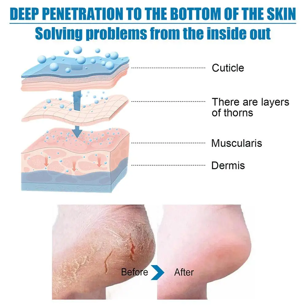 Botinhas de calo esfoliantes para cuidados com os pés, máscara Spa, nutrir cuidados, folha lisa, pele hidratante, pacote de pés V9W3, 1 par