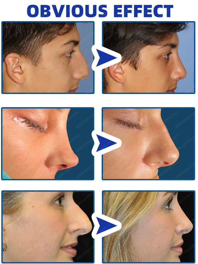 Minyak pengangkat hidung, minyak pemancung hidung, pembentukan ulang tulang hidung, perawatan alami murni, pelangsing hidung