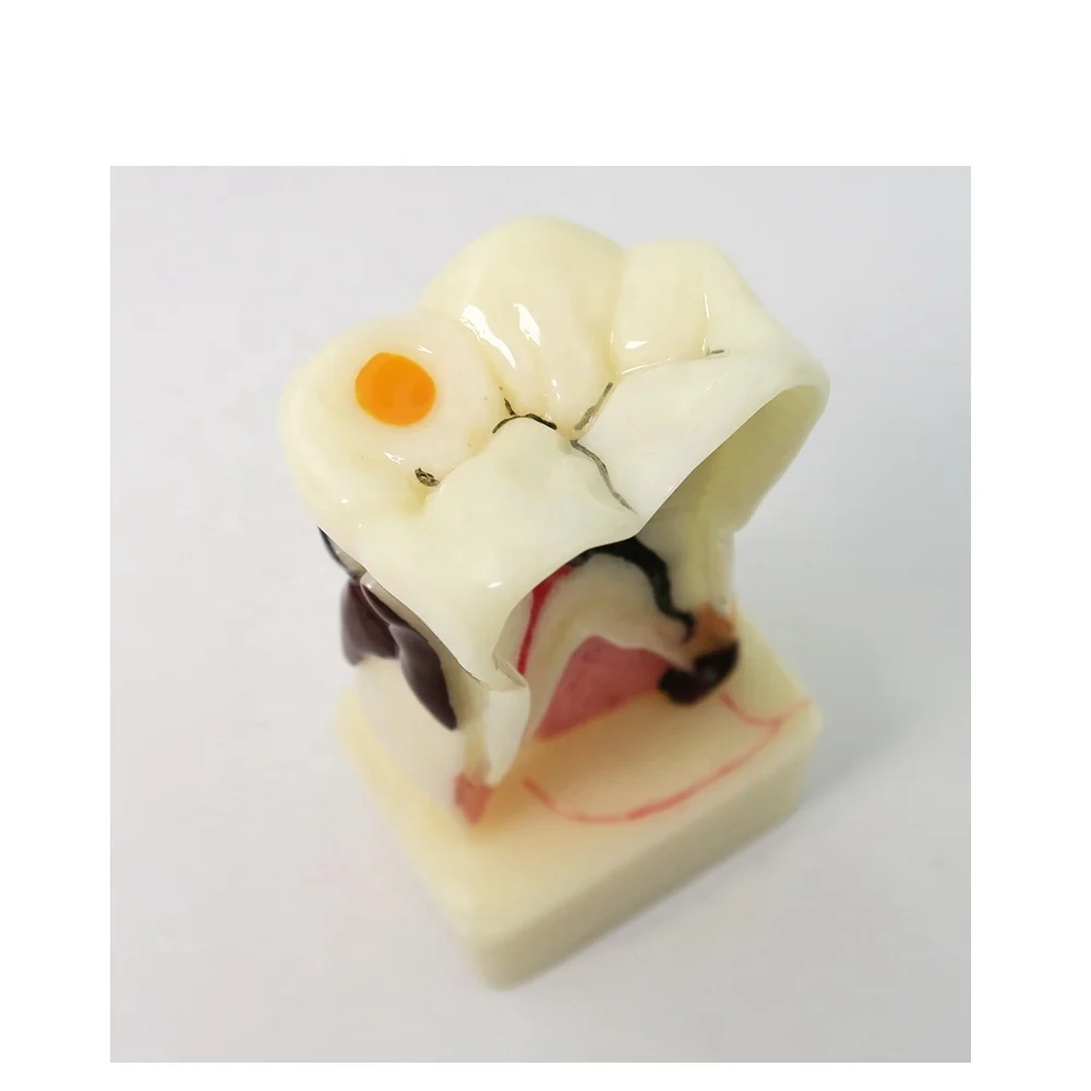 4-voudig Cariësdemonstratie Model Tandmodel