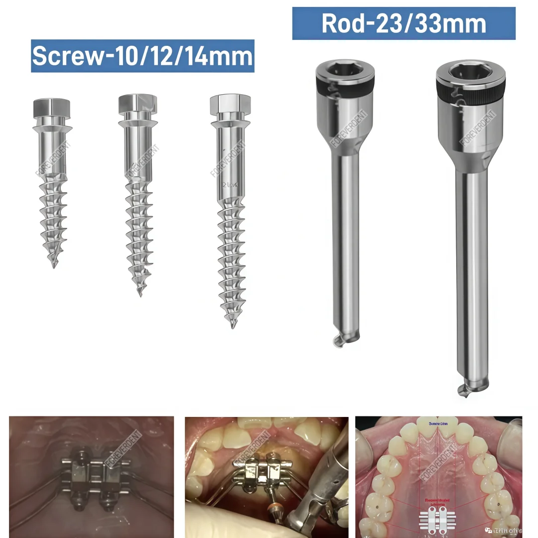MSE Dental Marpe Palatal Screw Rod Maxillary Skeletal Expander Orthopaedic Mid Facial Parallel Expansion Screw Rod Appliance
