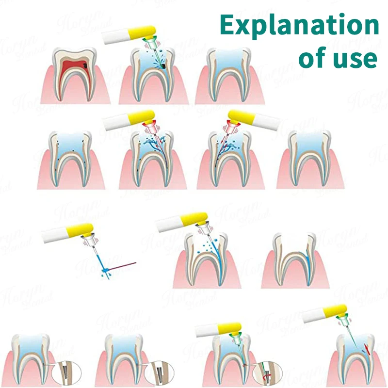 den tal Endo Sistema di attivazione sonica Irrigatore sonico endodontico Radice professionale con 120 punte Controllo manipolo di pulizia