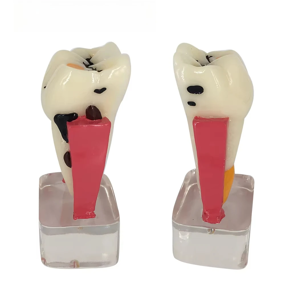 Dental Model Resin 4times Transparent Molar Anatomy Teeth Modeling With Nerves Medical Science Oral Dentist   Dentistry Products