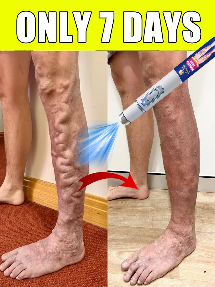 

2025 latest varicose vein laser pen, eliminate varicose veins