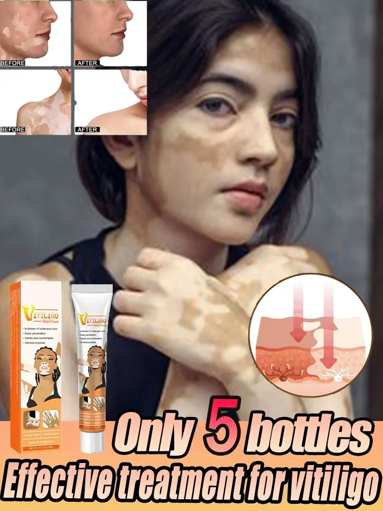 ⁿⁱᶜᵉ vitiligo magic tool