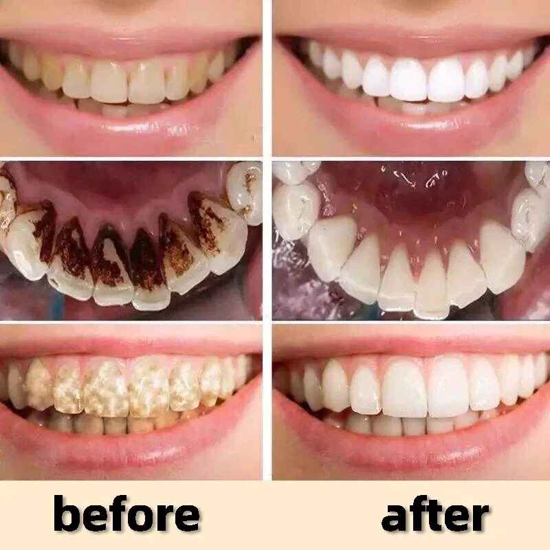 Removedor de cálculo Dental, blanqueador de dientes, eliminación de olores bucales, mal aliento, prevención de Periodontitis, nuevo, 2024