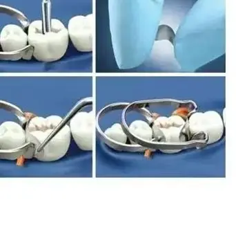 

Dental Matrix Bands Style Sectional Contoured Matrices Ring Wedges Clamp Plier Delta Wedges Dentistry Formed Sheet Tool