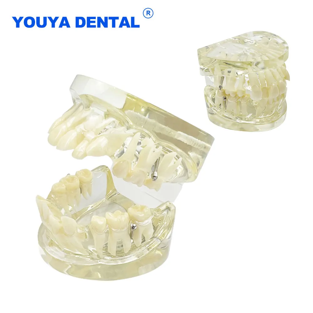 Dental Orthodontic Malocclusion Teeth Model Typodont Standard Teach Models for Patient Communication Dentistry Demo