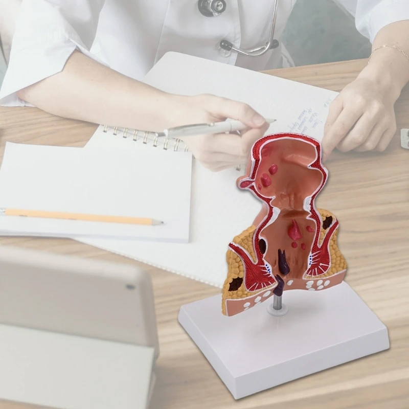 Модель человеческих патологий прямой кишки Модель прямой кишки человека Модель обучения медицине