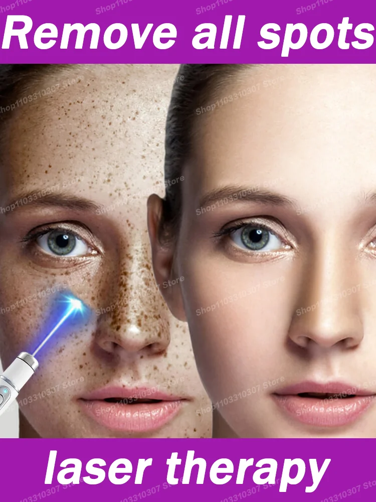 

Whitening Facial Spots Blu-ray pen