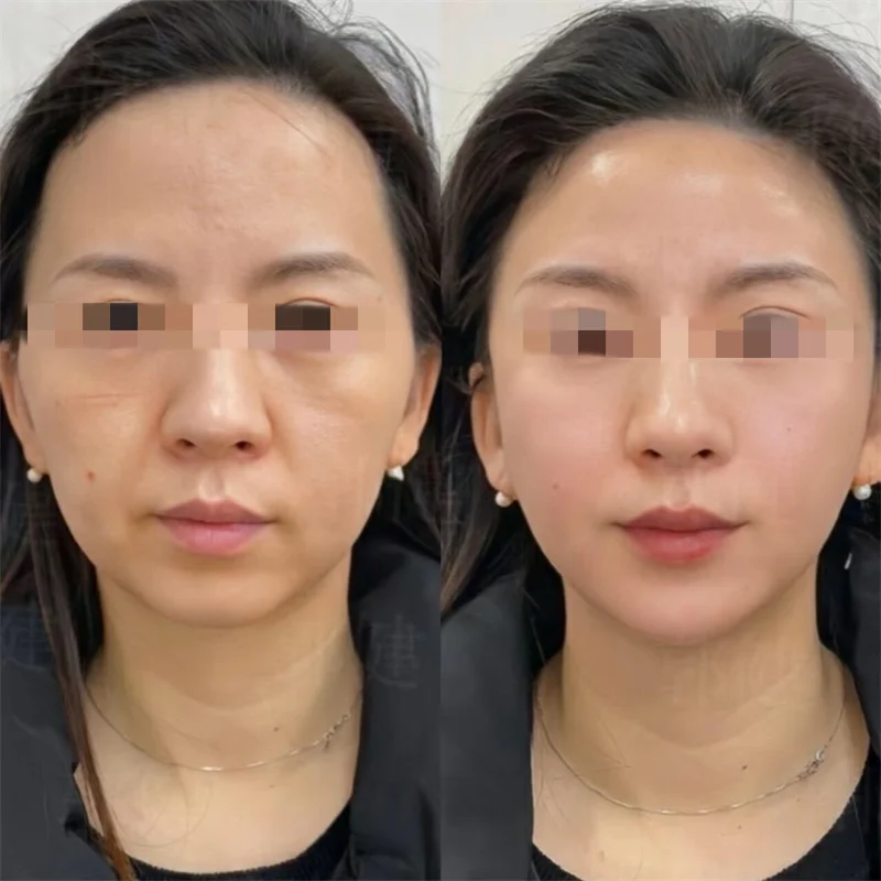 Tragbares Facelifting-Körpermassagegerät, Radiofrequenz, Mikrostrom, goldener Finger, RF, Ems, Schönheitsmaschine, Diamantfinger