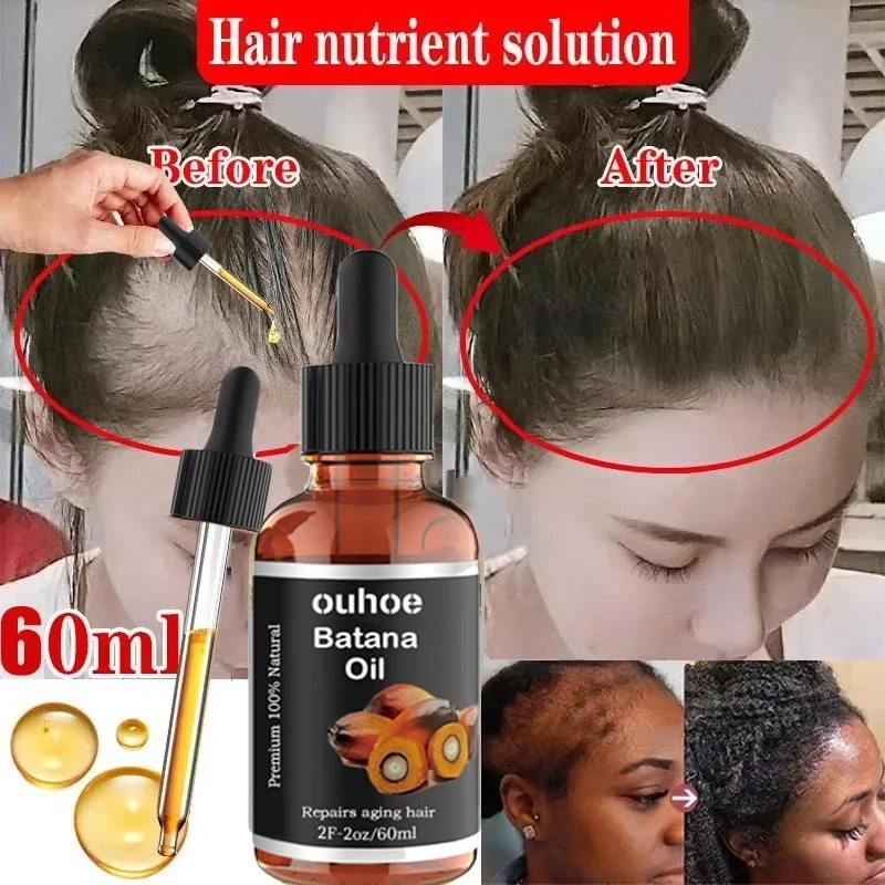 100% زيت باتانا النقي رذاذ نمو الشعر للرجال والنساء مكافحة فقدان الشعر إعادة نمو زيت طبيعي علاج فروة الرأس منتجات العناية بالشعر #1
