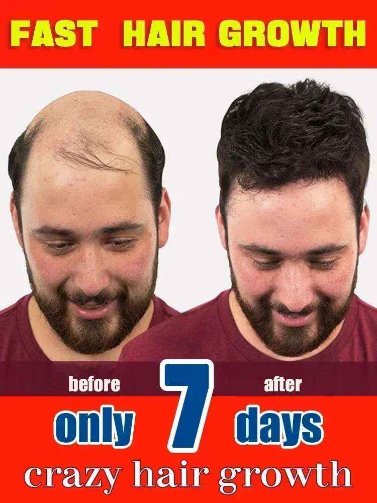 Hot selling product, 99% of buyers buy again, have more and more hair, say goodbye to baldness, thick hair