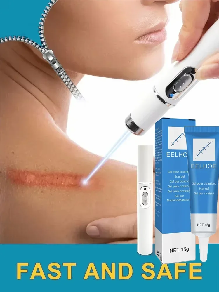 Laser therapie Keloid narben