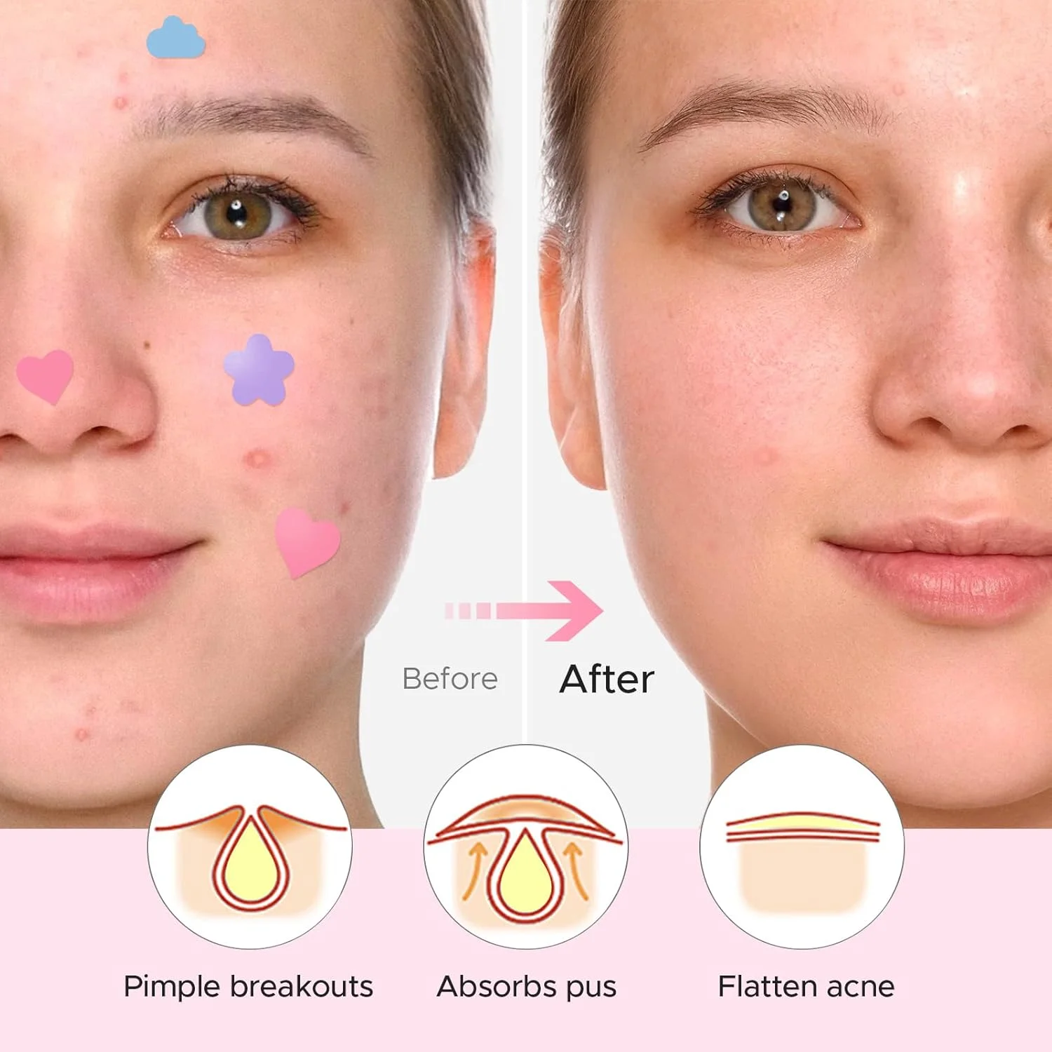 Star Acne Patch Dissolvenza Riparazione Adesivi invisibili per la rimozione dell'acne Simpatico correttore Strumento per il trucco Stile stella con scatola di immagazzinaggio a specchio