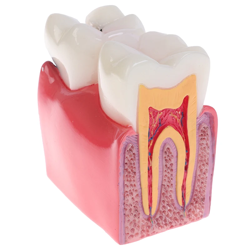 1PCS Dental Materials Lab Teeth Model 6 Times Caries Comparation Study Models For Dentist Studying and Researching