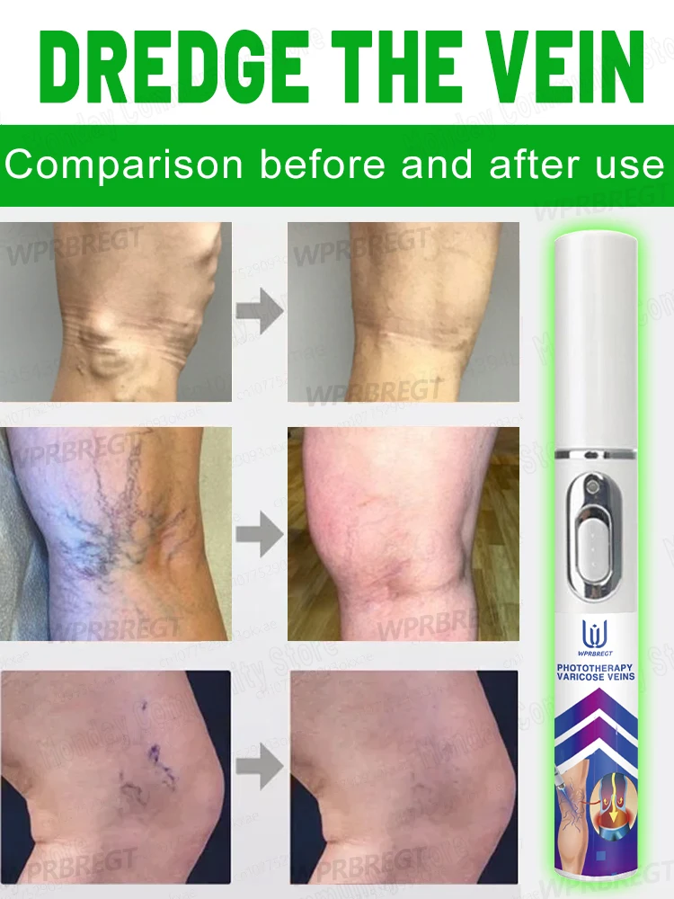 Pᴀɪɴʟᴇss ᴀɴᴅ ɴᴏɴ-ɪɴᴠᴀsɪᴠᴇ, ᴅᴇᴇᴘʟʏ ʀᴇʟɪᴇᴠᴇs ᴠᴀʀɪᴄᴏsᴇ ᴠᴇɪɴs, ᴇᴀsɪʟʏ ʀᴇʟɪᴇᴠᴇs