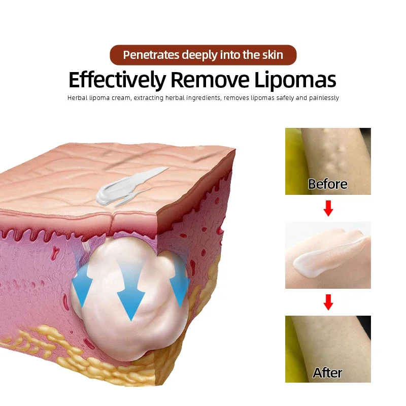 Lipoma Cream Subcutaneous Lumps Remover Treatment Medicine Liquid Apply To Skin Swelling Cellulite Fibroma Fat Mass Plaster