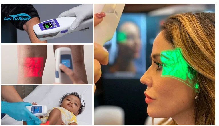 infrared medical handheld AV300 Medical Device vein finder Images Facial Vein Locator Vein Viewer