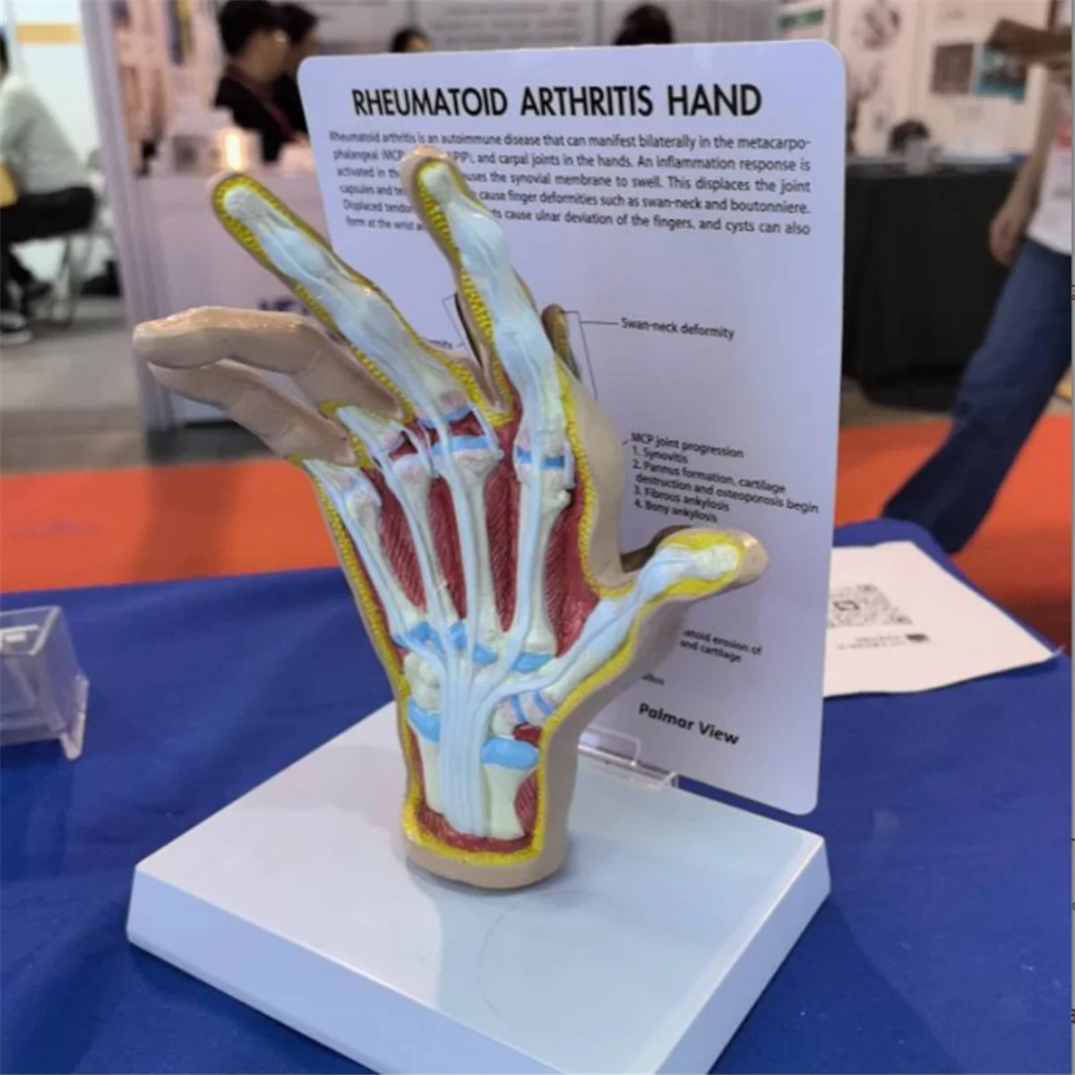 Osteoarthritis Hand Model, Model of Hand Pathology, Human Anatomy and Physiology Replica, Doctor'S Office Anatomy Model