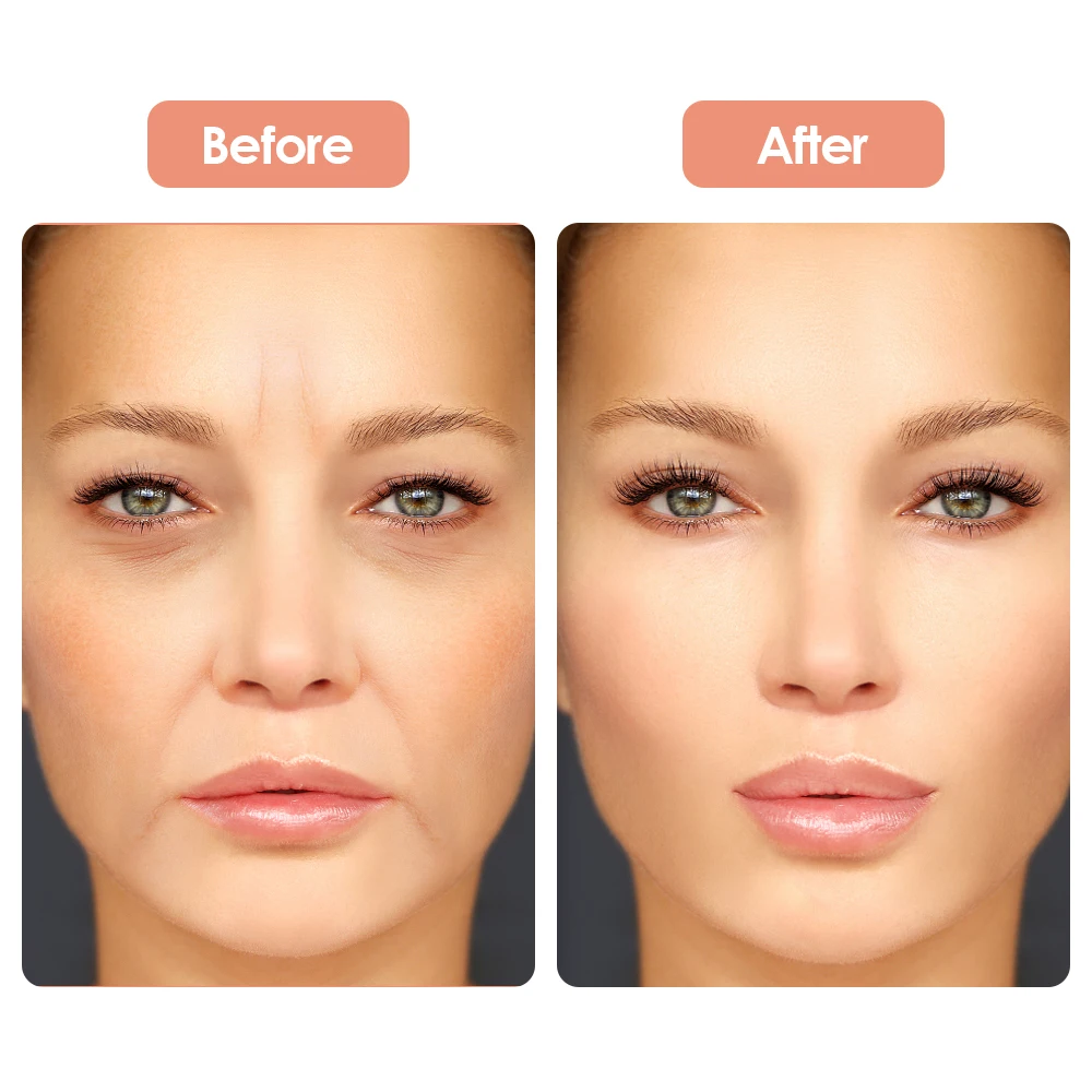 5 ชิ้นซิลิโคนกําจัดริ้วรอยสติกเกอร์ Anti - wrinkle Face หน้าผากสติกเกอร์ Face Lifting Care Patch Anti Aging Beauty เกินไป