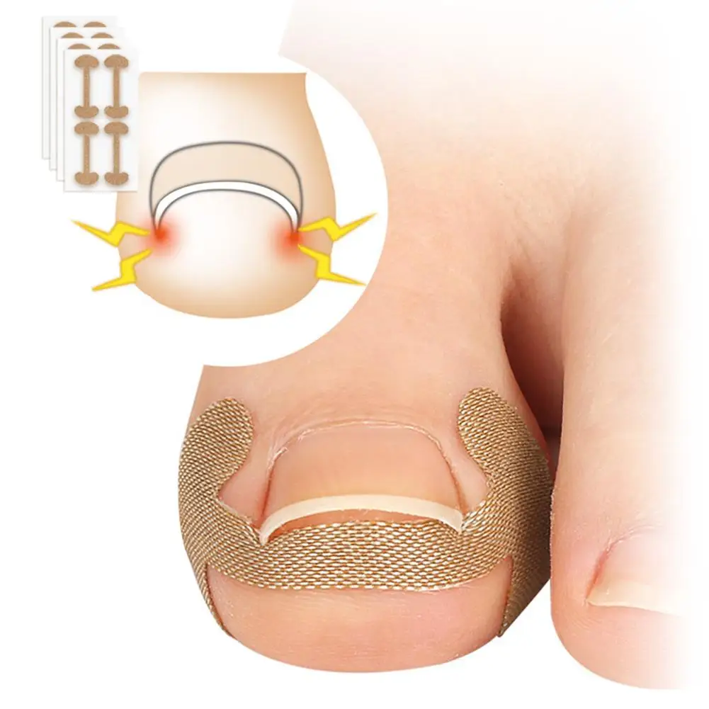 

12sets Adult Ingrown Paronychia Toenail Corrector Strips Anti Nail Patch Feet Sleeping Nail Patch Nails into the Flesh Long