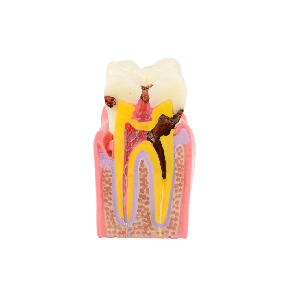 Den tal Teeth Model Den tal Caries Tooth Model for Patient Education and Explanation