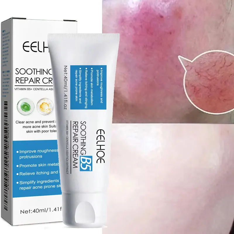 

Vitamin B5 Facial Redness Acne Scar Soothing Repair Face Cream Relieves Stinging Acne Prone Sensitive Skin Care Korean Cosmetics