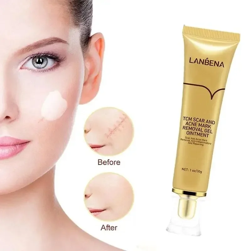 LANBENA Acne Scar Stretch Marks Remover Cream Skin Repair Acne Black Dots Spots Acne Treatment Blackhead Bleaching Cream 30ml