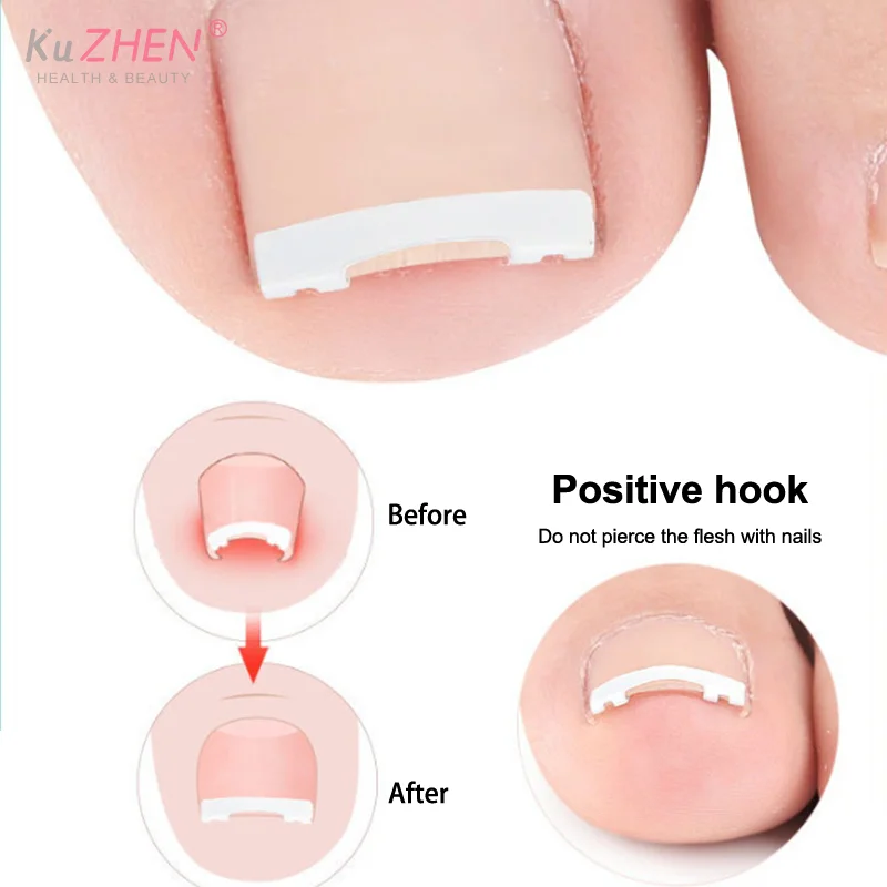 1PCS Ingrown Toenai…