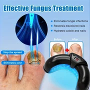 

1/2/4 Pcs Nail Fungus Light Device for Multiple Fingernails & Toenails