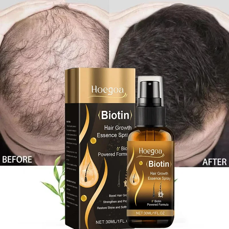 Spray de biotina para el crecimiento rápido del cabello, suero antipérdida para prevenir la calvicie, tratamiento para el cuero cabelludo, Barba, esencia de belleza, productos para el cuidado del cabello, 30ml