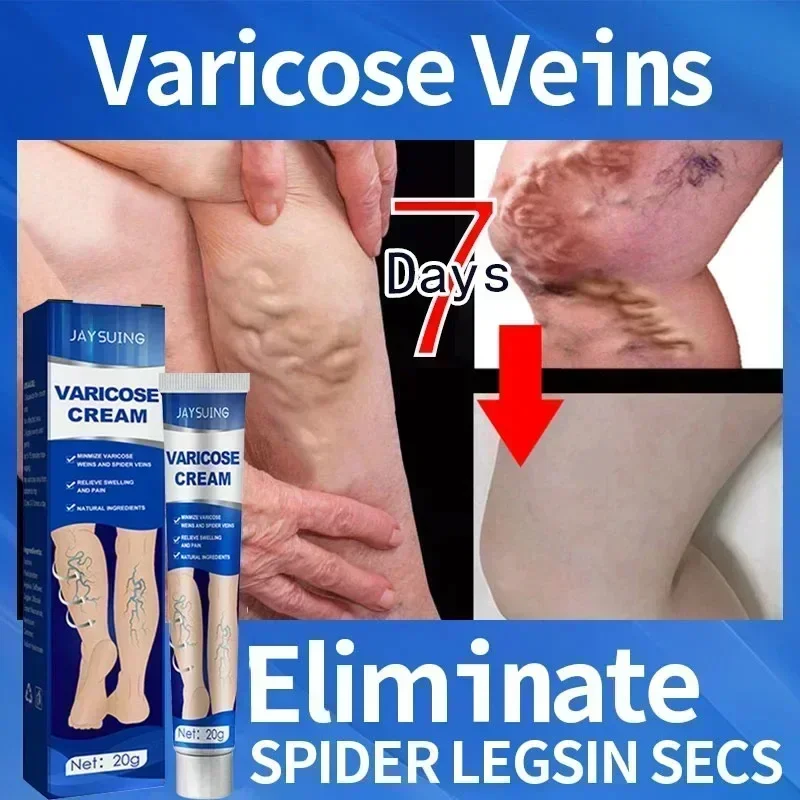 Varicose Vein Treatment Ointment Relieves Leg Fatigue, Dilated Vasculitis, Venositis, Spider Pain Relief Ointment, Body Ointment