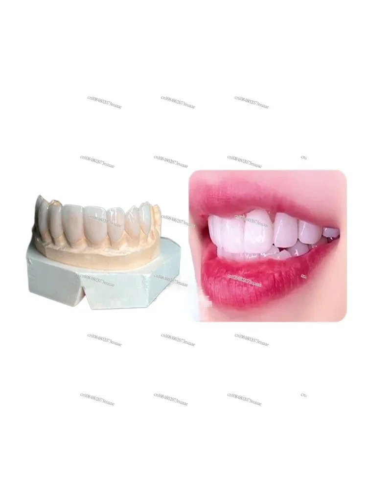 All-porcelain tooth stickers imported blue porcelain amber porcelain Lingxi porcelain ultra-thin tooth veneers