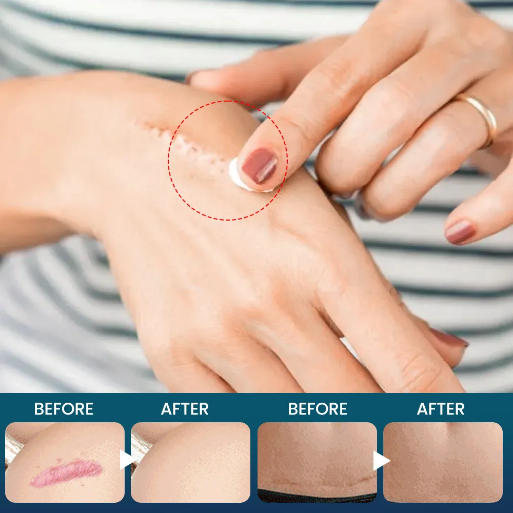 라벤더 오일이 함유된 천연 흉터 제거 젤, 오래된 흉터, 튼살, 수술 후 흉터, 여드름 자국 개선