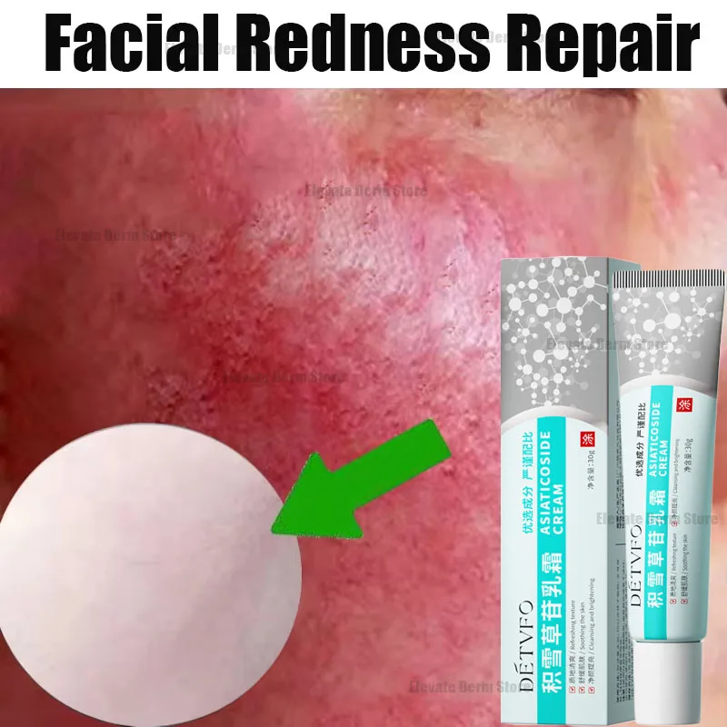 Repair Facial Redness Cream Instant Spider Vein Remove Sensitive Skin Sooth Anti Redness Rosacea Treat Lotion Korean Cosmetics