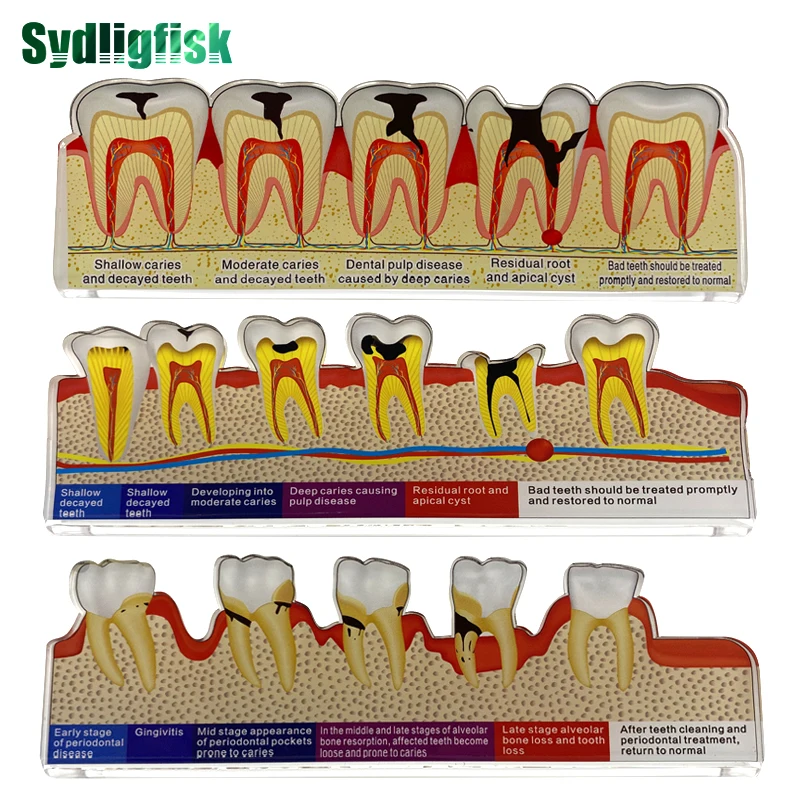 

Dental Model Disease Tooth Model Dental Caries Model Teaching Model Doctor-Patient Communication Models Dentist Gift Dentistry