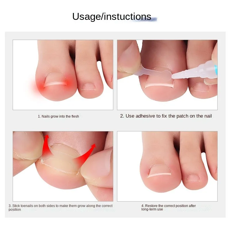 10pcs Ingrown Toe Nail Treatment Ingrown Toenail Correction Tool Elastic Patch Sticker Straightening Clip Brace Pedicure Tools