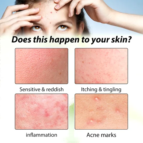 Imagen 2 del producto 3RD crema antiacné eficaz elimina los nódulos de la piel Pustules Cysts Papulos puntos negros hombres y mujeres acné cuidado de la piel crema de esencia