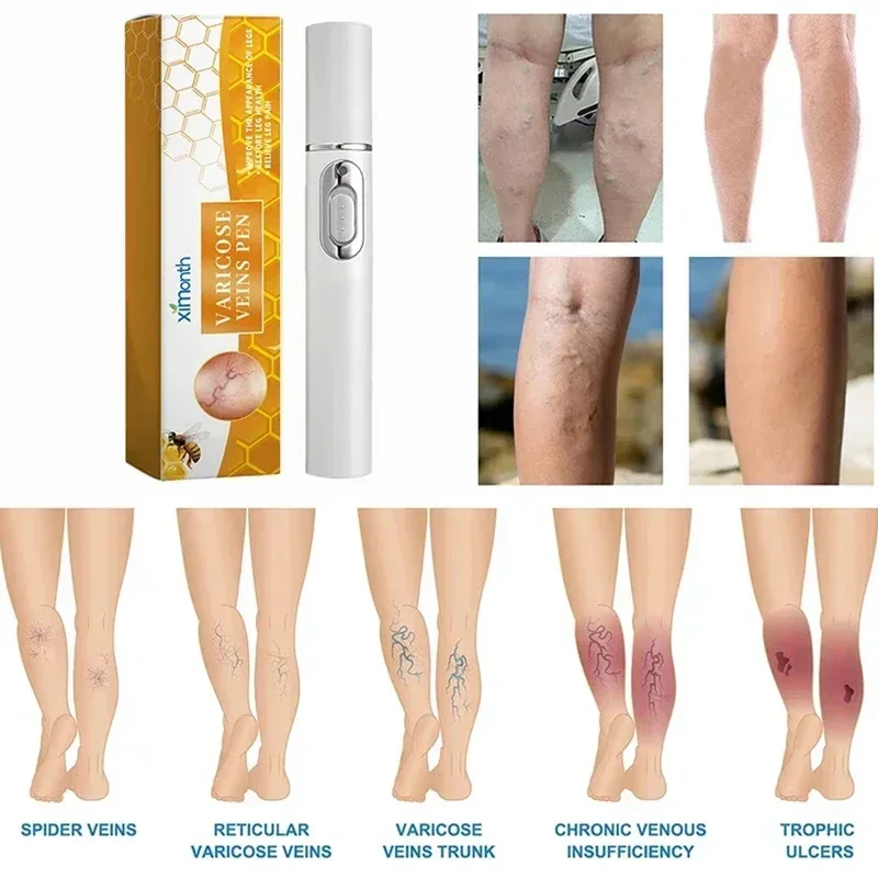 Stylo de réparation des jambes pour thérapie au laser, produit de soin de la peau, SAP imconfortable pour les jambes, améliorant le surpoids sanguin, stylo pour varices