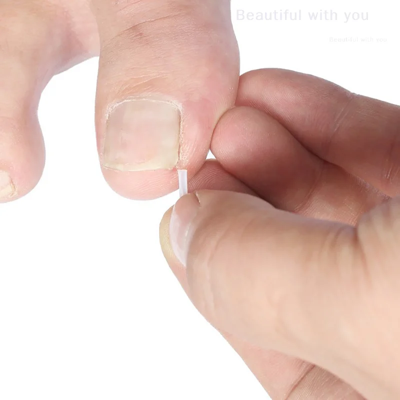 10 unids/pack Clip alisador de uñas de los pies herramienta de corrección de uñas encarnadas tratamiento de uñas parche elástico pegatina cuidado de los pies pedicura