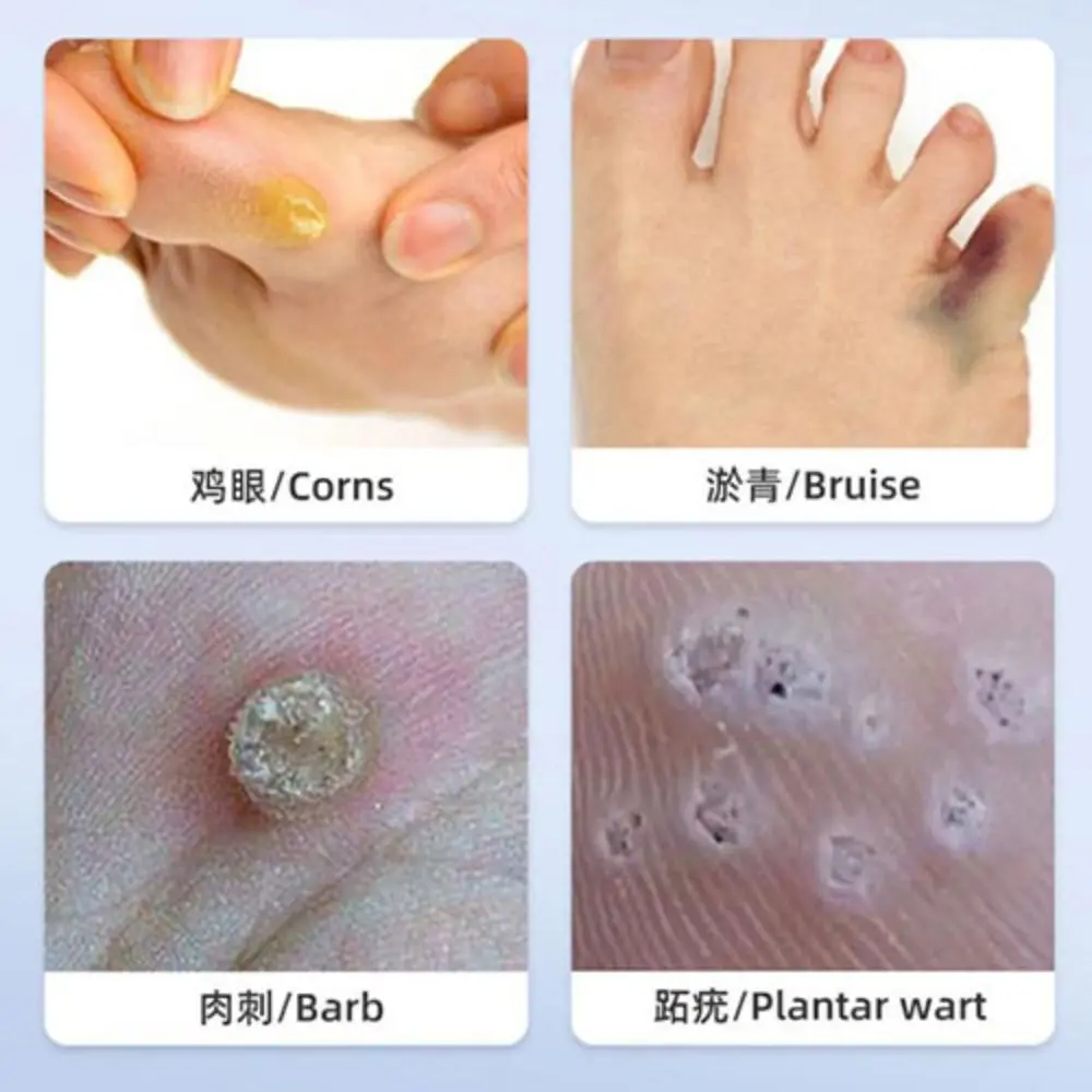 Convenient Toe Pain Care Protection Plas Relief Feet Corn Foot Pads Heel Patch Latex Corn Patch