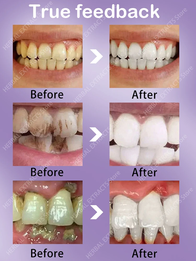 Prodotti per i denti schiuma sbiancante placca dentale calcolo